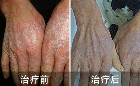 手部银屑病好的案例
