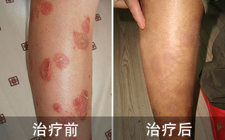 腿部牛皮癣好的案例