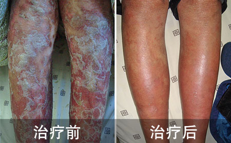 好的男性腿部银屑病的案例