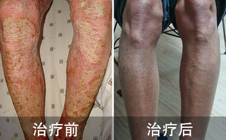 老孙好的腿部银屑病的案例