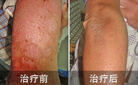 胳膊肘银屑病治好的病例