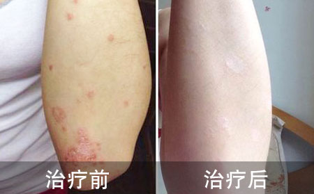 好的脓疱性银屑病的案例