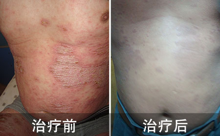 好的全身银屑病的案例