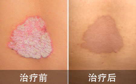 背部脓疱性银屑病好的案例