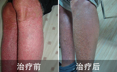 农民好的腿部银屑病的案例