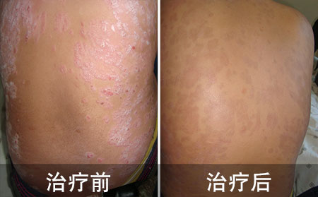 好的跳舞女孩的背部银屑病