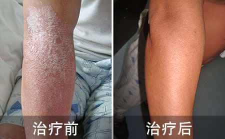 血热型银屑病好的病例