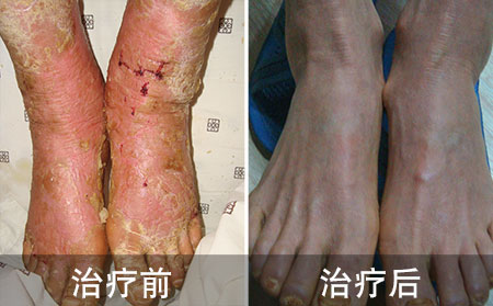 好的多年银屑病的案例