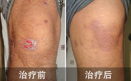 多年脓疱性银屑病好的案例