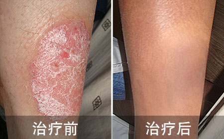双腿银屑病好的案例