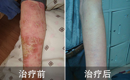 女孩子好的银屑病的案例