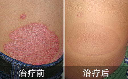 乡村教师好的顽固银屑病