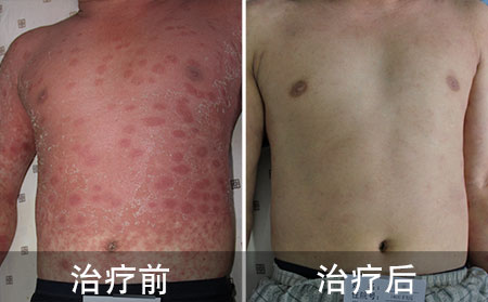 王玉明治疗银屑病恢复病例图