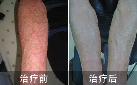 手臂银屑病好的案例