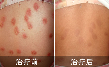 好的全身银屑病的病例