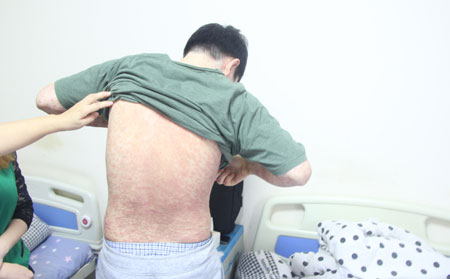 牛皮癣护理