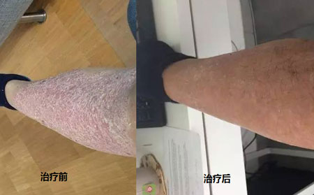 高先生腿部牛皮癣治疗效果
