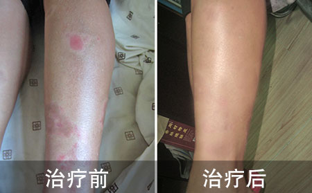 女孩治疗银屑病案例
