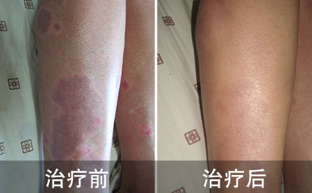 学霸治疗牛皮癣案例