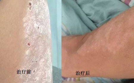 银屑病好的案例