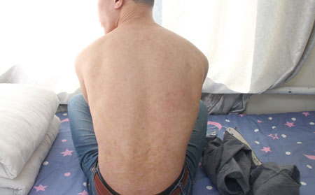 银屑病治疗