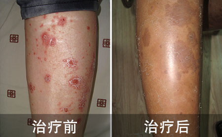 银屑病好的案例