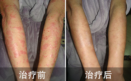胳膊银屑病案例对比图