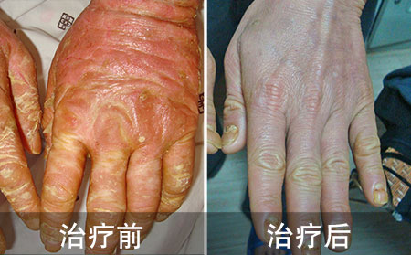 关节型银屑病案例图
