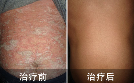 顽固的红皮型银屑病案例