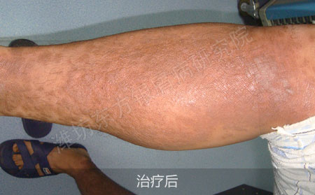 潍坊东方治疗银屑病效果好
