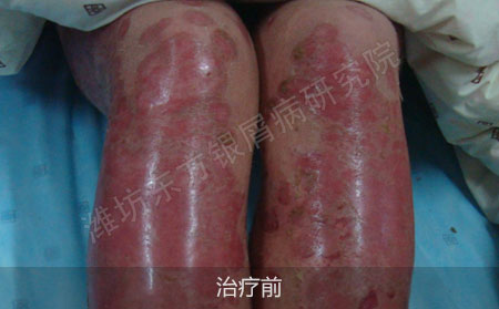 潍坊治疗银屑病医院哪家可以