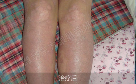 红皮型银屑病要怎么治疗