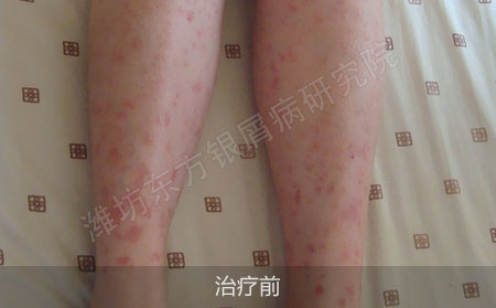 潍坊治疗银屑病哪家医院可以