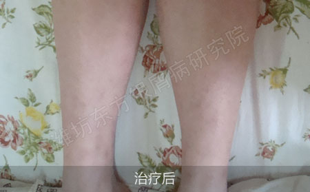 银屑病要怎么治疗