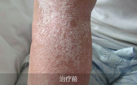 潍坊治疗银屑病医院哪家可以