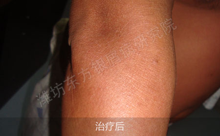 银屑病要怎么才能正规有效治疗