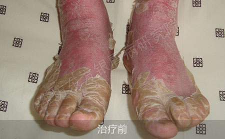 潍坊治疗银屑病医院哪家可以