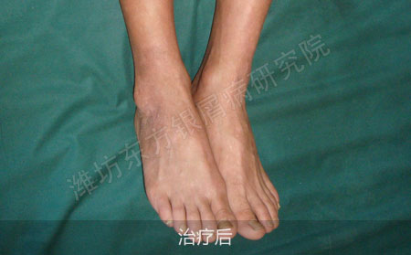 银屑病怎么才能正确治疗
