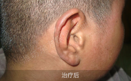 银屑病红肿皮损要怎么有效治疗