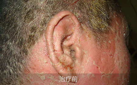 潍坊治疗银屑病医院哪家效果好