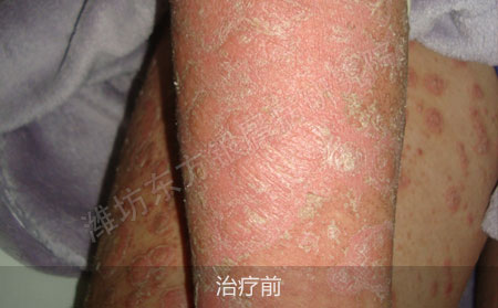 潍坊治疗银屑病医院哪家可以