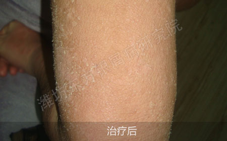 脓疱型银屑病怎么治疗才有效