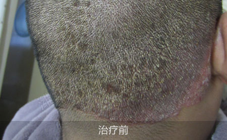 潍坊哪家医院治疗银屑病效果好