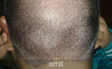 头部银屑病要怎么治疗才有效