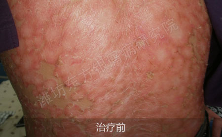 潍坊治疗银屑病医院哪家效果好