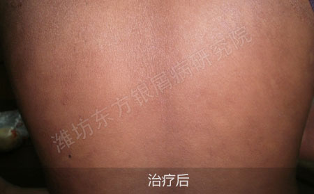 背部银屑病用中药治疗效果怎么样