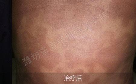 顽固银屑病要怎么治疗才能恢复
