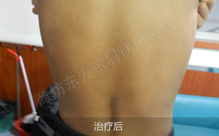 红斑顽癣银屑病怎么治疗才有效