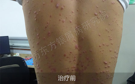 潍坊治疗银屑病医院哪家可以