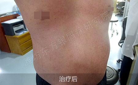 红皮型银屑病怎么治疗才有效